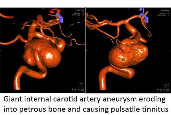 Giant carotid aneurysm